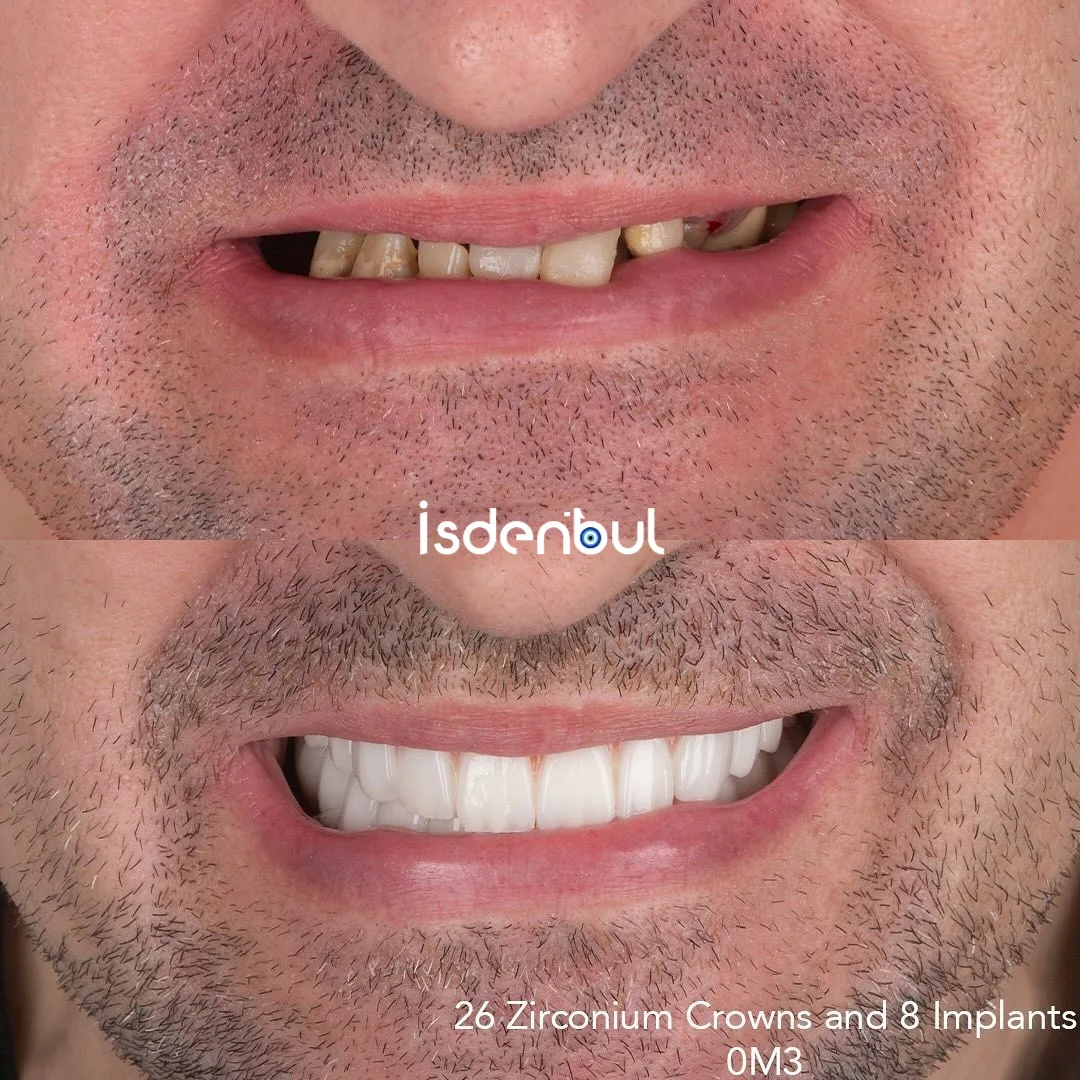 Before & After — 26 Zirconium Crowns and 8 Implants