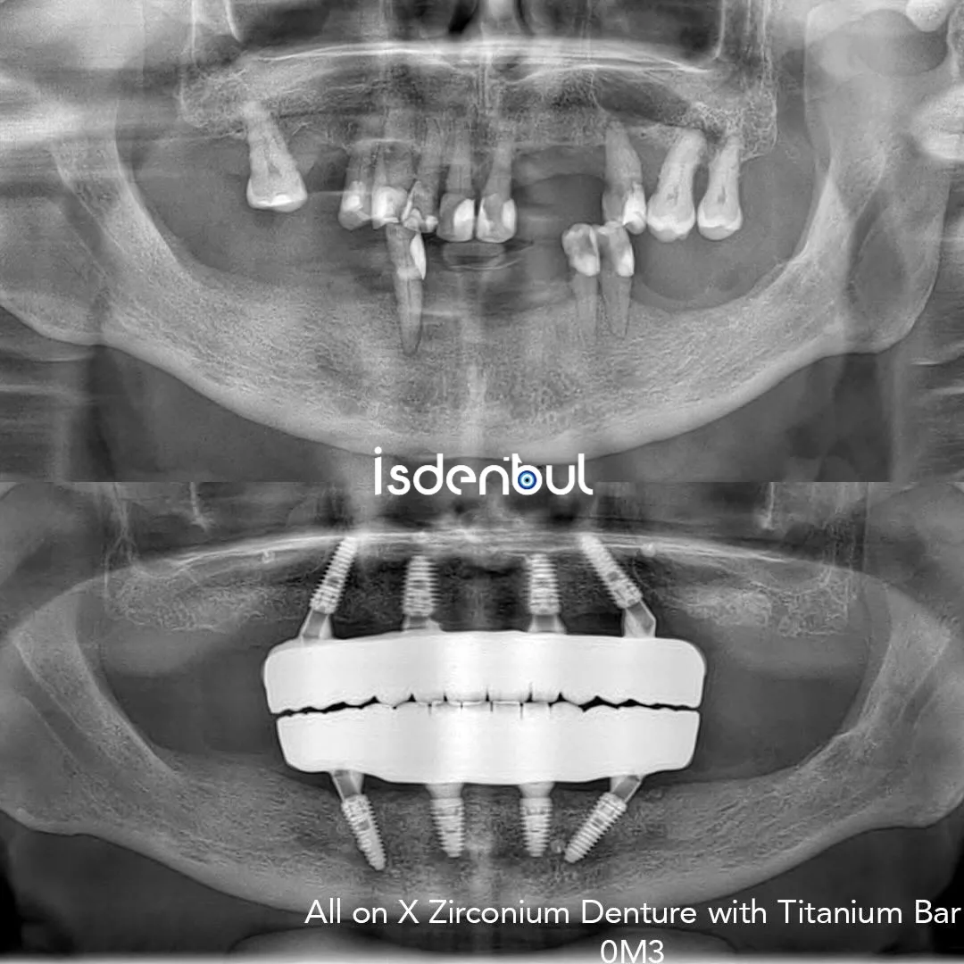 Before & After X-Ray — All-on-X Zirconium Denture