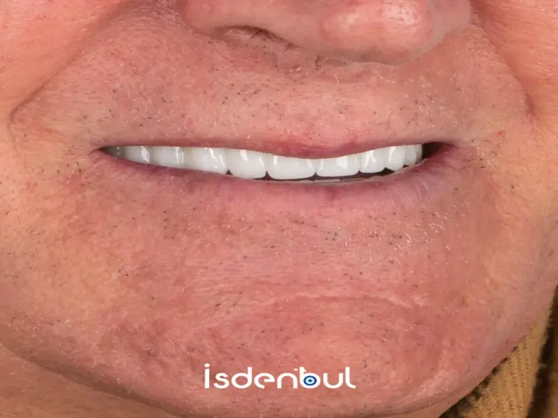 Dental Veneers