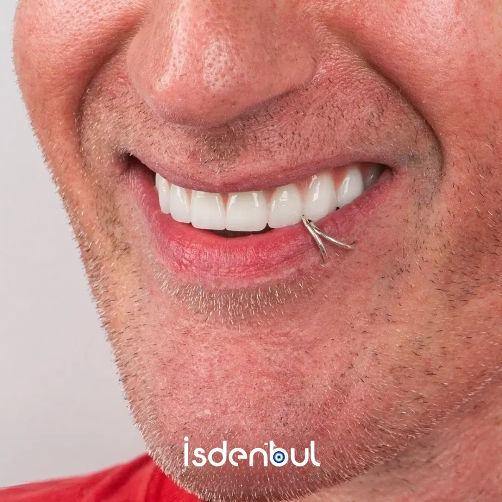 Zirconium Crowns result